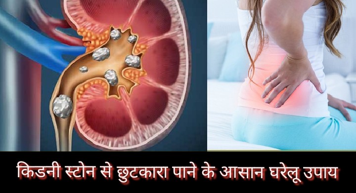 Kidney Stone Pain Home Remedies