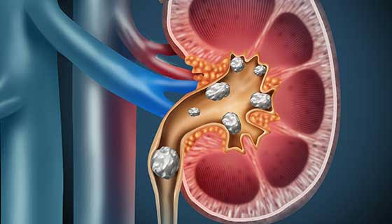 Kidney Stone Pain Home Remedies Kidney Stone Pain Home Remedies