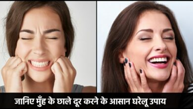 Mouth Ulcer