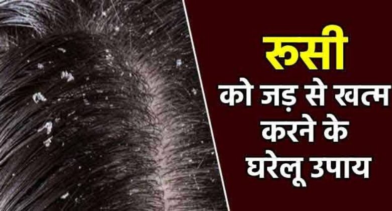 Dandruff Ko Dur Karne Ke Ghrelu Upaay
